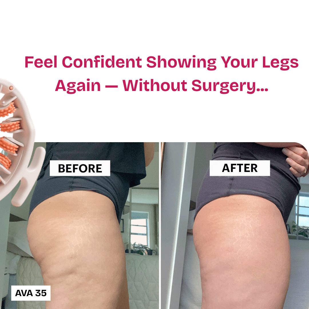 Coreify™ Anti - Cellulite Roller - Coreify
