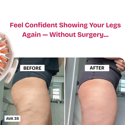Coreify™ Anti - Cellulite Roller - Coreify